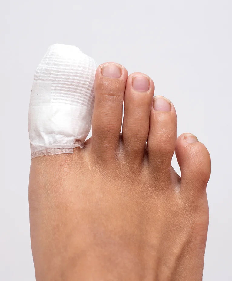 Ingrown Toe Nails: Causes, Treatment, and Prevention
